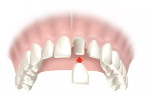Цемент для временной фиксации