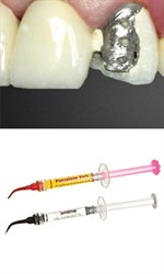 Материалы для восстановления сколов керамики