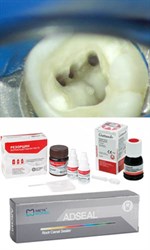 Материалы для эндодонтии