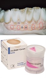 Десневые массы