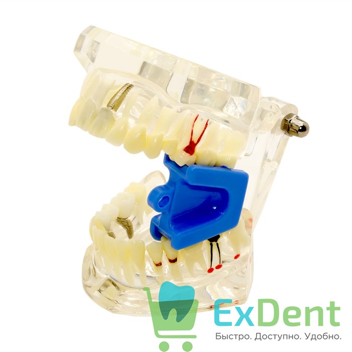 Прикусной блок средний, для фиксации челюсти в открытом состоянии 18200 - фото 26509